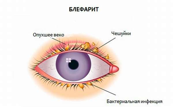 почему болят глаза при простуде - схема блефарита